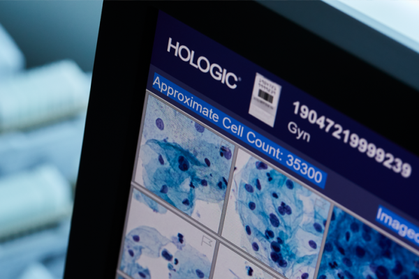 Cytologiprover på objektsglas och hörnet av en skärm som visar digitala cytologisvar, redo för analys.