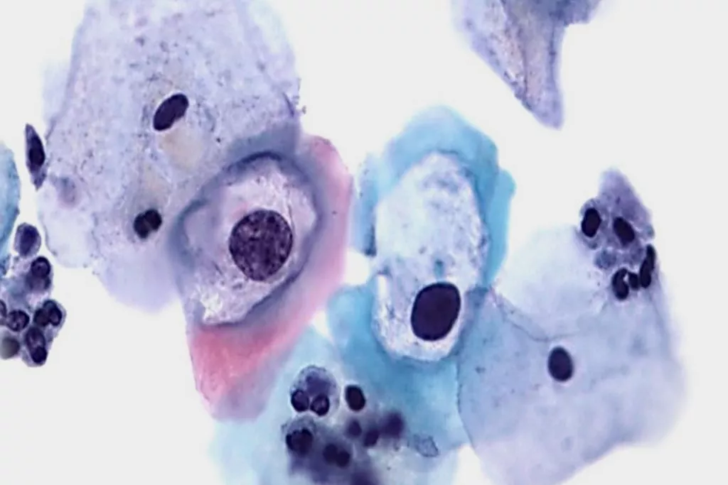 Cellprov med låggradig dyskaryos med HPV