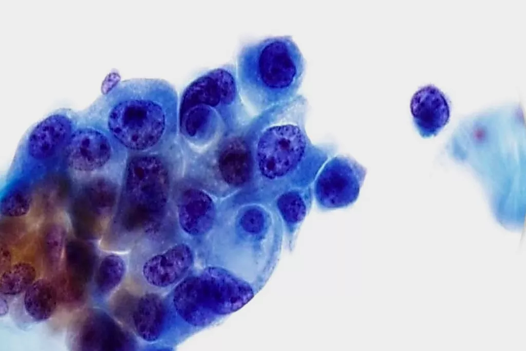 Urotelialt karcinom, grad 3, urin, Papanicolaou-färgning