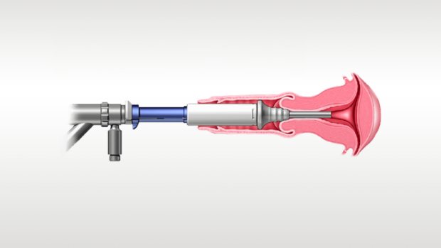 Illustrationen visar en medicinteknisk enhet som används.